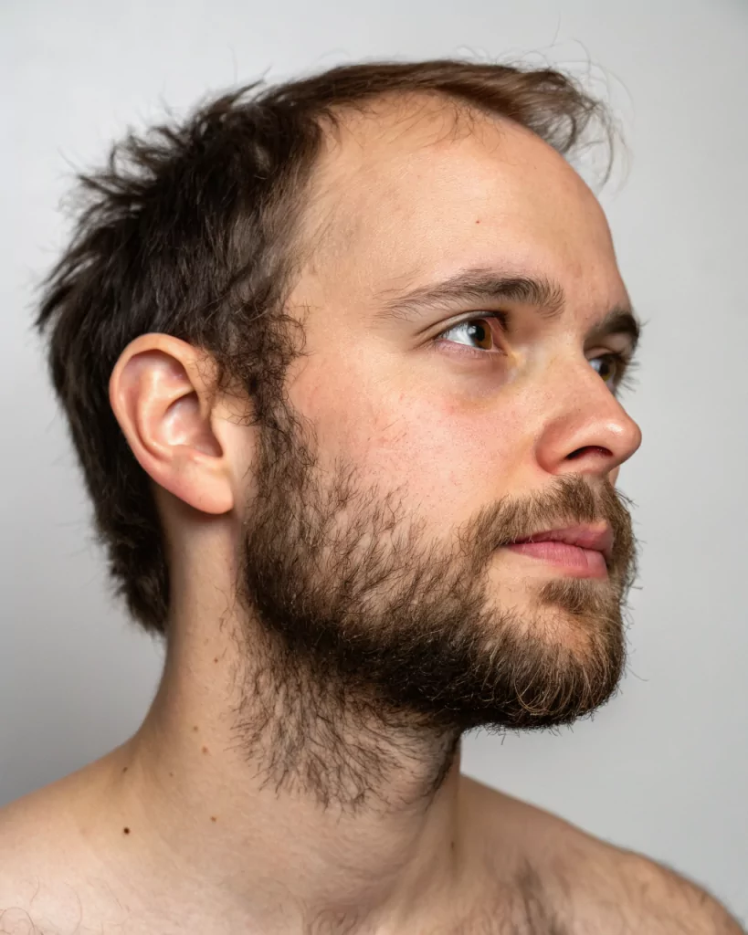 Пересадка волос на лицо: трансплантация бровей, усов и бакенбард. Сколько стоит и где можно сделать?