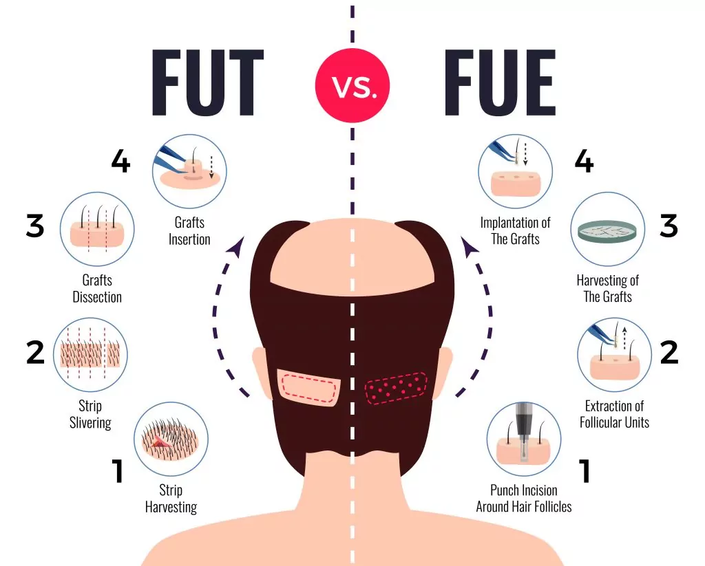 Графт и FU: различия. Чем FUT отличается от FUE?.jpg 33259.jpg